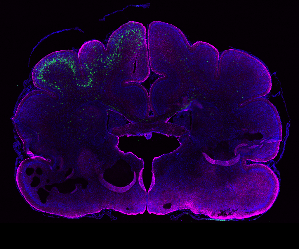 Genetic manipulation in the ferret brain (age: postnatal day 16). Neural stem cells in the left hemisphere were electroporated in vivo 24 days earlier. GFP+ neurons (green) have their cell bodies in the electroporated hemisphere and extend their processes to the contra-lateral hemisphere. Magenta, GFAP (glial cell marker); blue, DAPI (nuclei). Credit: Kalebic et al., eLife 2018;7: e41241.