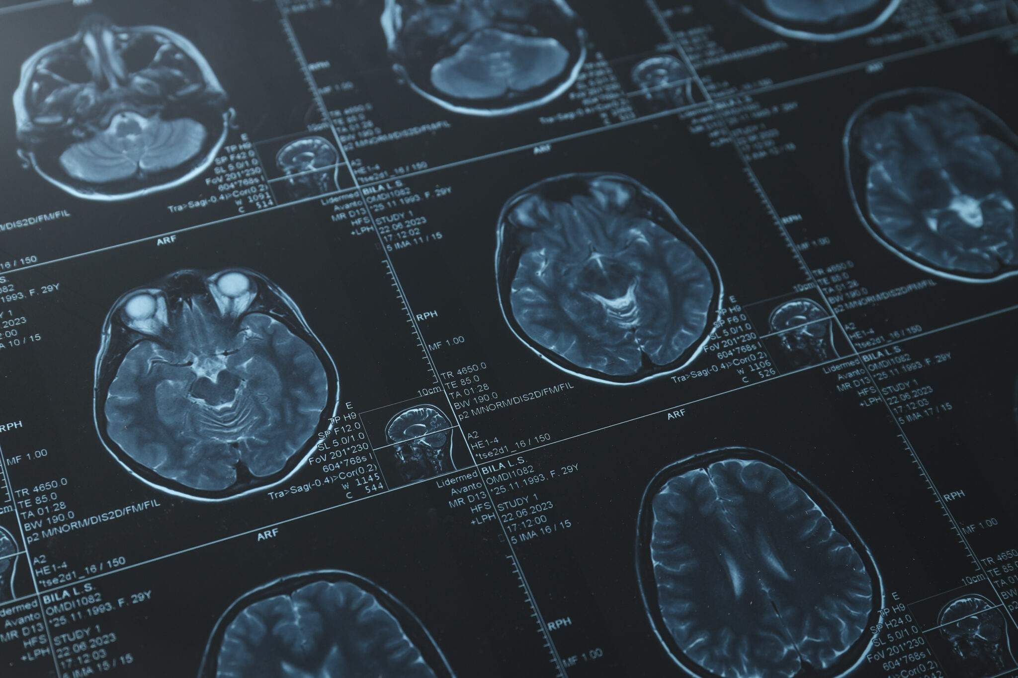 Understanding the pathogenesis of SARS-CoV-2 encephalitis - Human ...